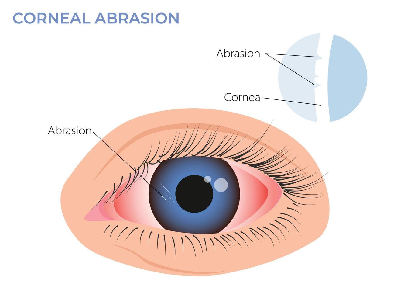 corneal abrasión ilustración. ojo enrojecimiento síntoma. rosado rojo de surfista ojo vector