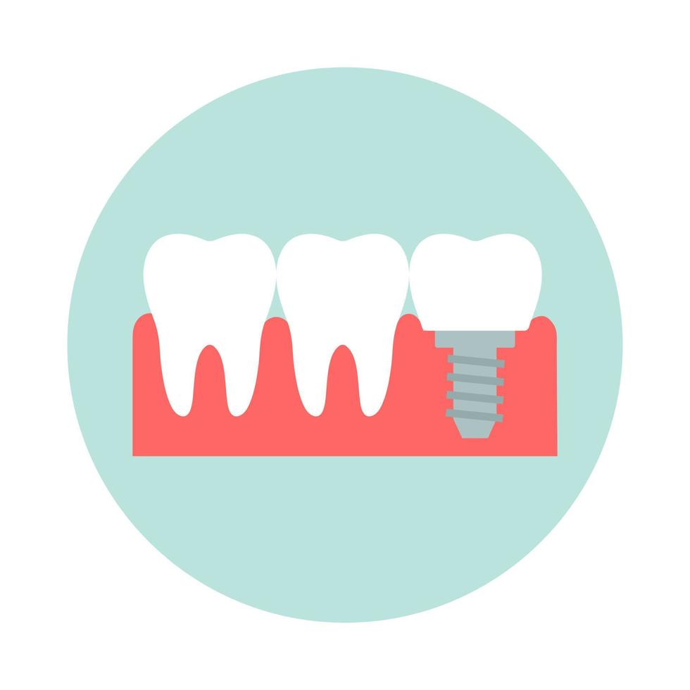 sano dientes con dental implantes plano diseño vector ilustración.