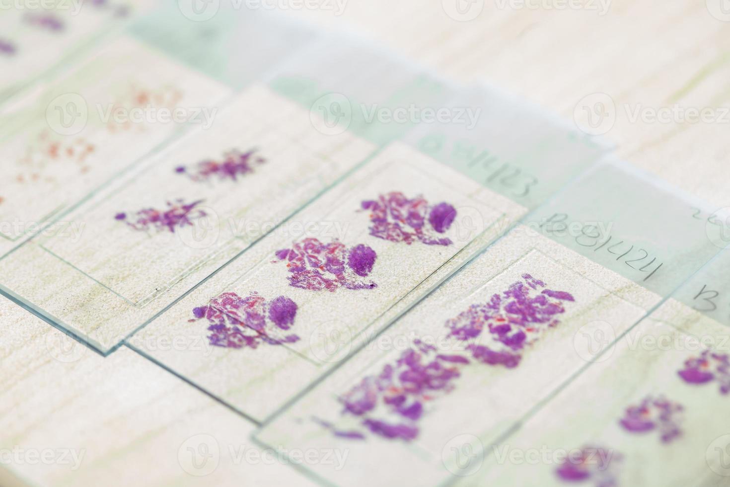 Stained tissue biopsy on glass slides in pathology laboratory photo