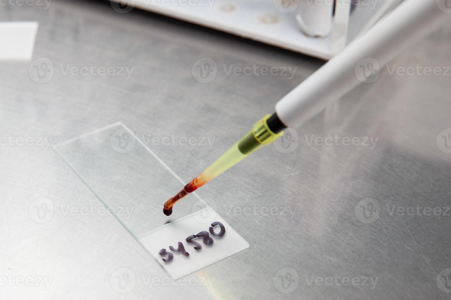 Bone marrow smear preparationin the laboratory. Blood smear preparationin the laboratory. photo