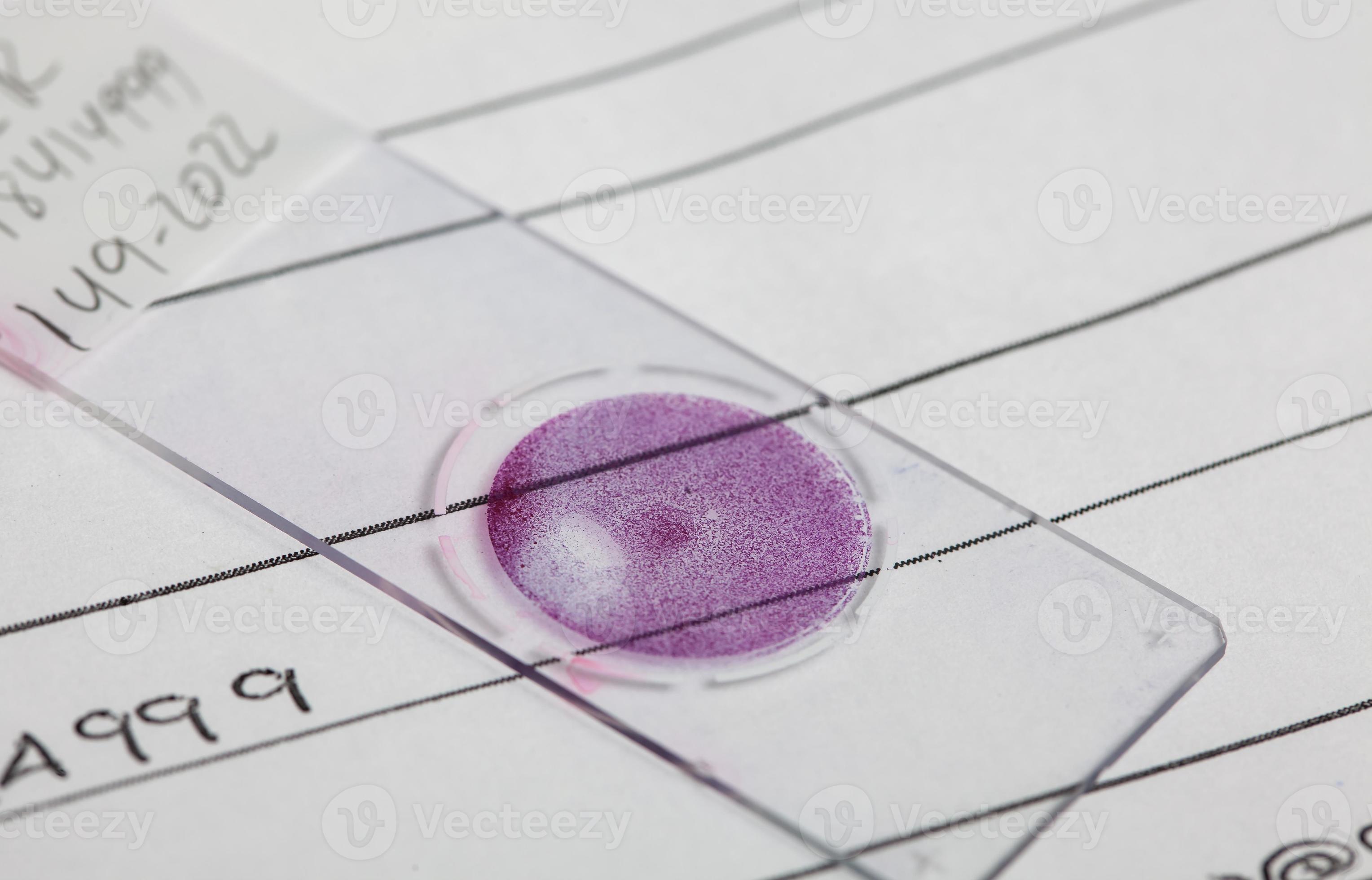 Liquid based cytology microscope slide for pap smear test. Cervical