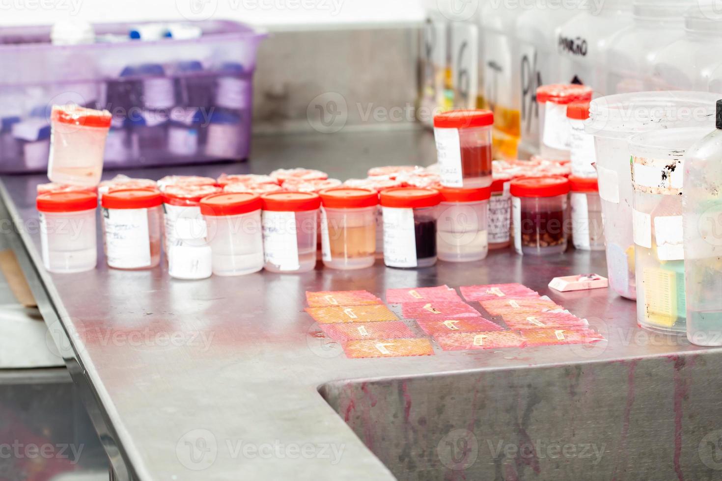 Biopsy samples being processed at the pathology laboratory to be embedded in paraffin for analysis. Cancer diagnosis concept. Medical concept. photo
