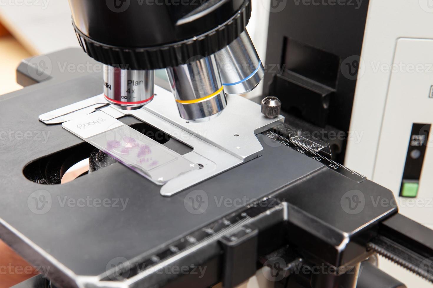Closeup of a microscope slide with stained tissue biopsy under the microscope. Cancer diagnosis