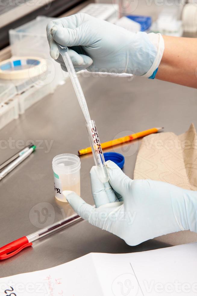 Scientist preparing a peritoneal fluid sample for cytology analysis in the laboratory. Cancer diagnosis concept. Medical concept. photo