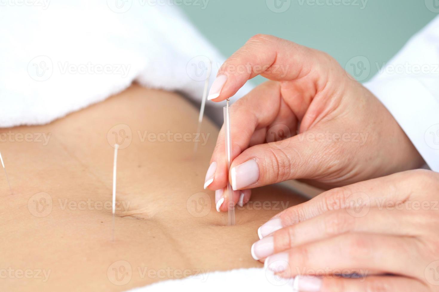 médico ejecutando un abdominal acupuntura procedimiento en un hembra paciente foto