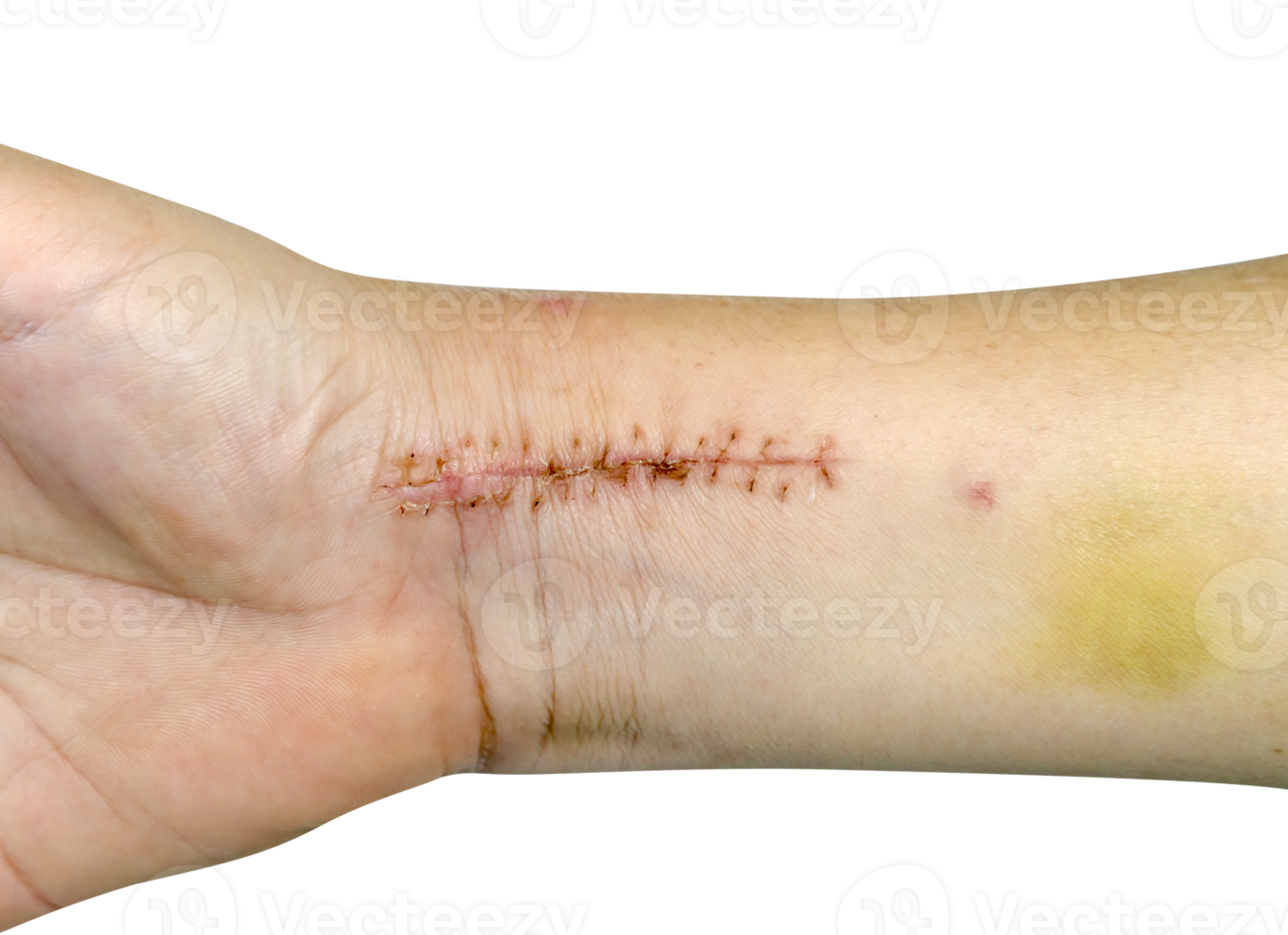 closeup stitches from broken arm surgery and bruised isolated png