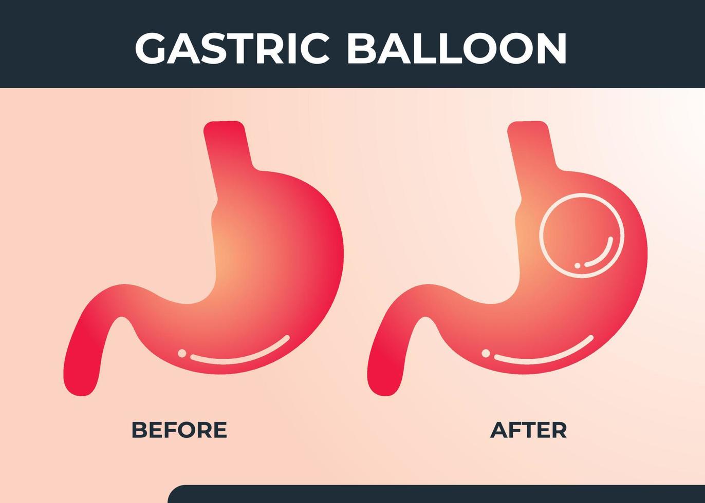 endoscopia estomacal balón gástrico dentro de un estómago cirugía de pérdida de peso ilustración vectorial obesidad vector