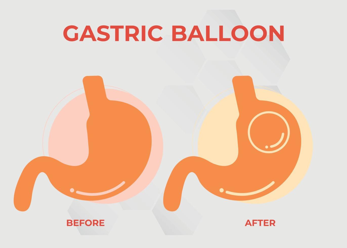 endoscopia estomacal balón gástrico dentro de un estómago cirugía de pérdida de peso ilustración vectorial obesidad vector