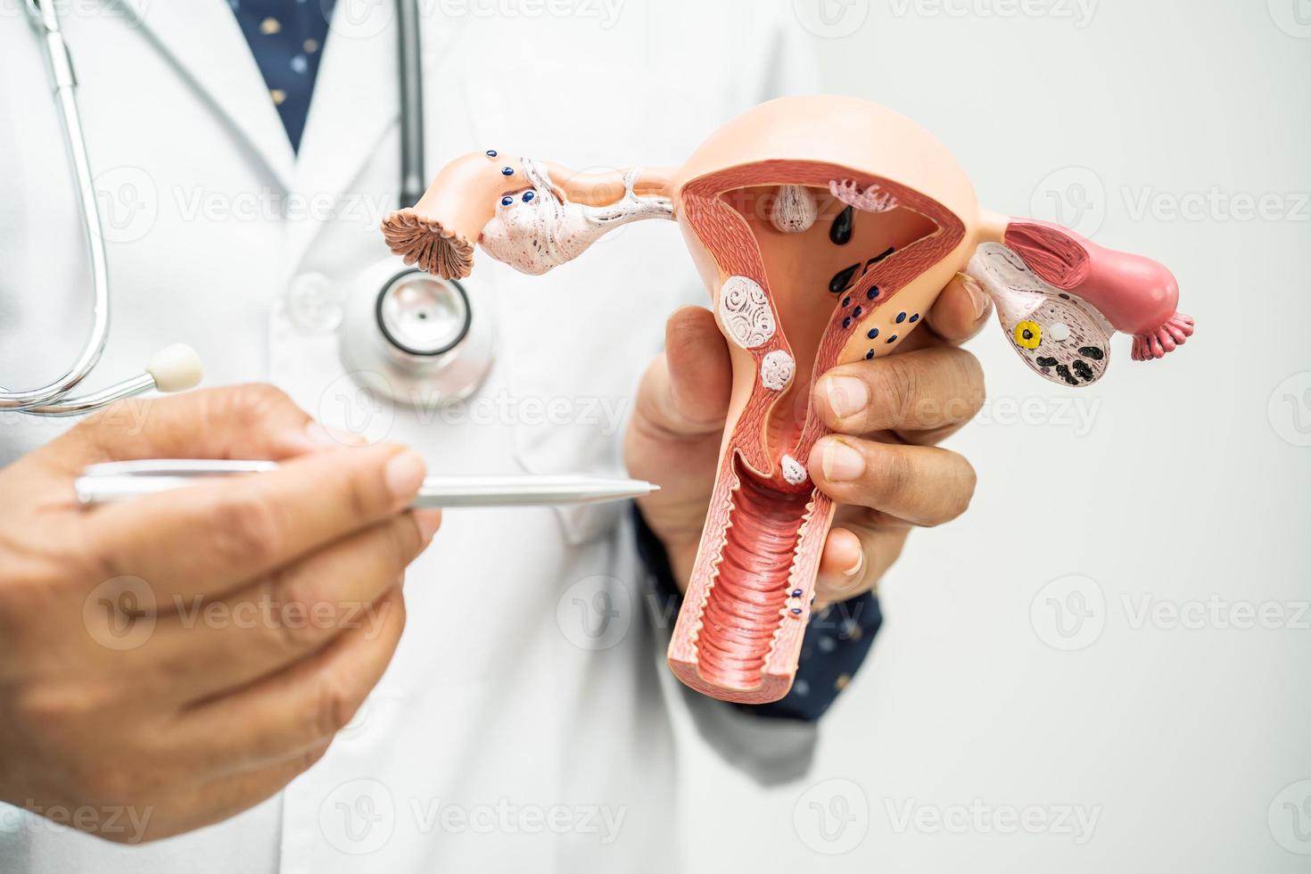 Uterus, doctor holding anatomy model for study diagnosis and treatment in hospital. photo
