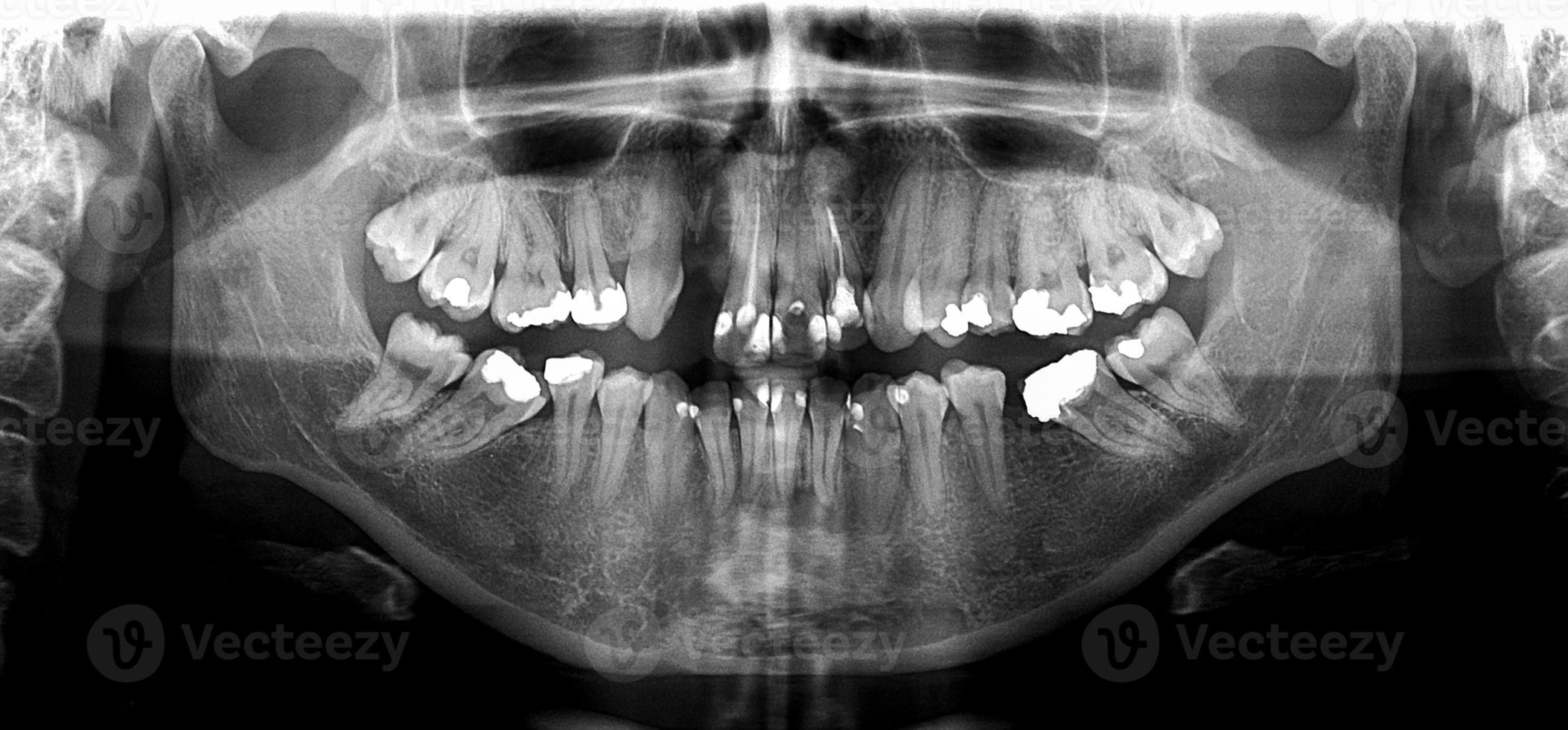 X ray of human mouth photo