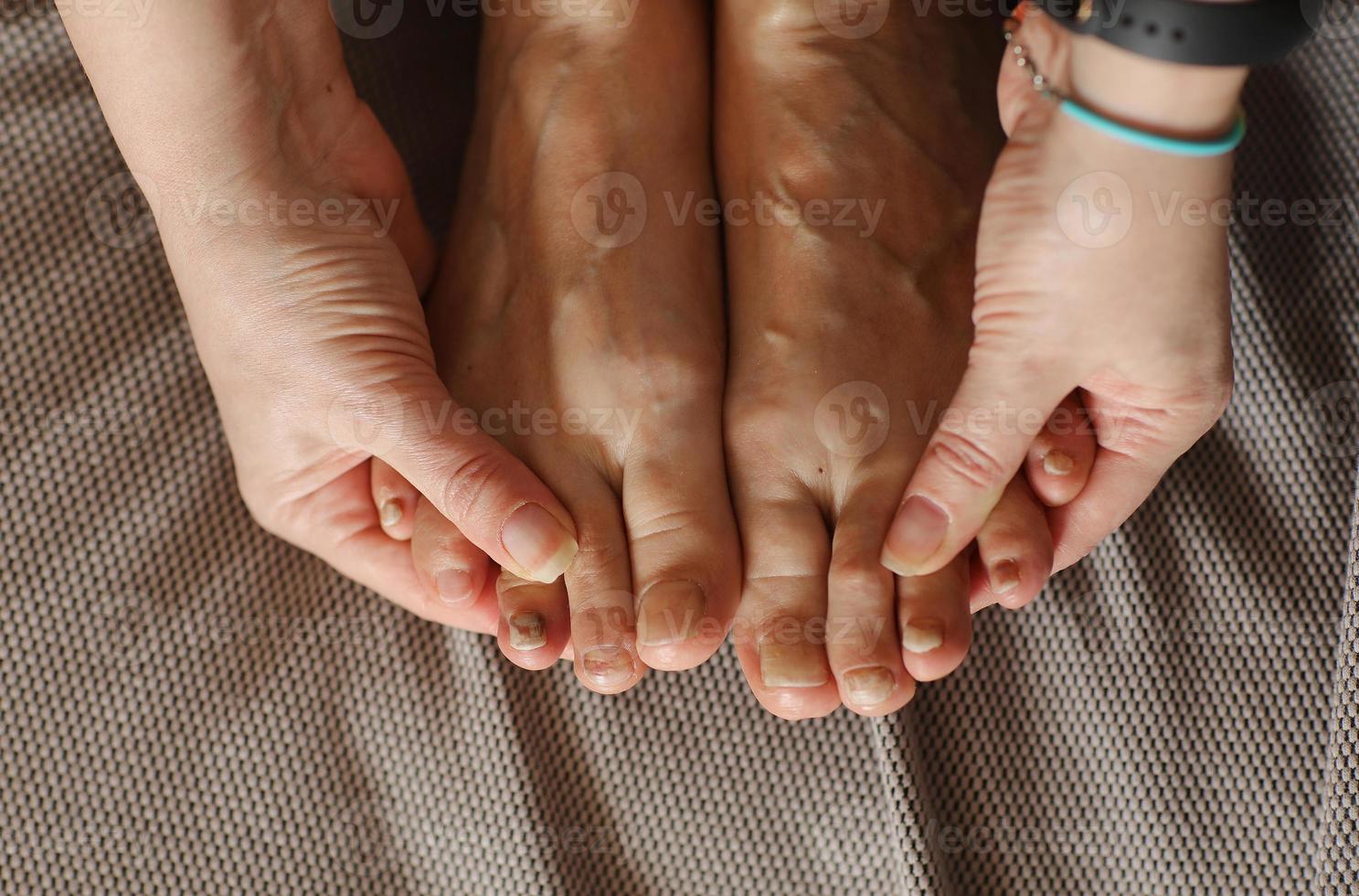 Female showing feet with subungual hematoma, black toenails caused by trauma, fungal infection or chemotherapy. Person suffering from onychomycosis, a fungal infection causing yellowing of the toenail photo