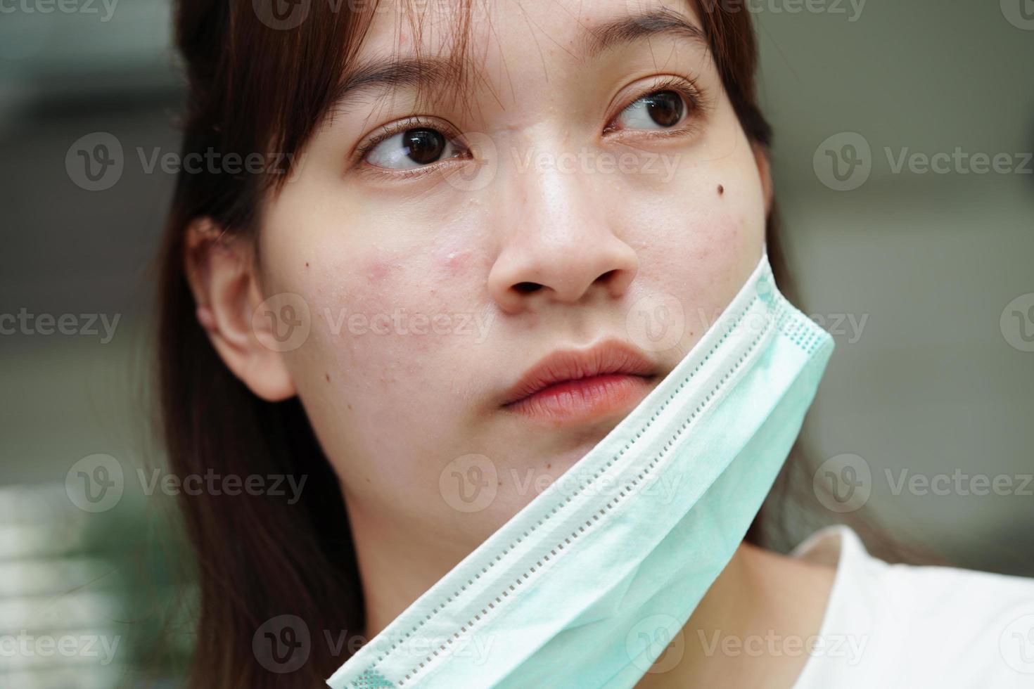 grano de acné y cicatriz en la cara de la piel, trastornos de las glándulas sebáceas, problema de belleza del cuidado de la piel de las adolescentes. foto