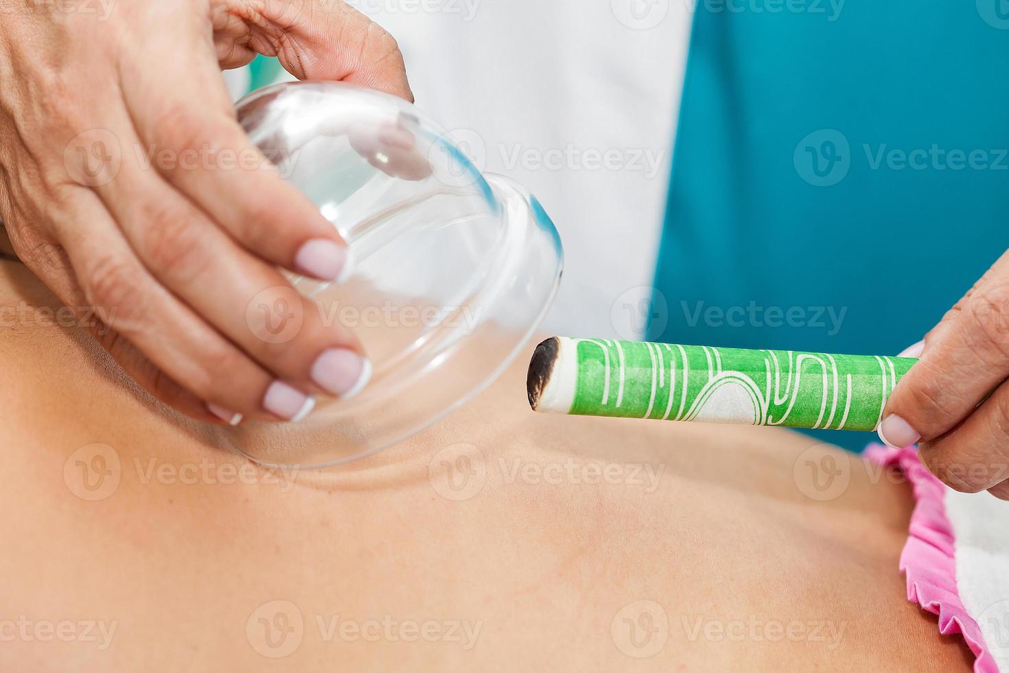 Doctor performing a moxibustion therapy on a young female patient back photo