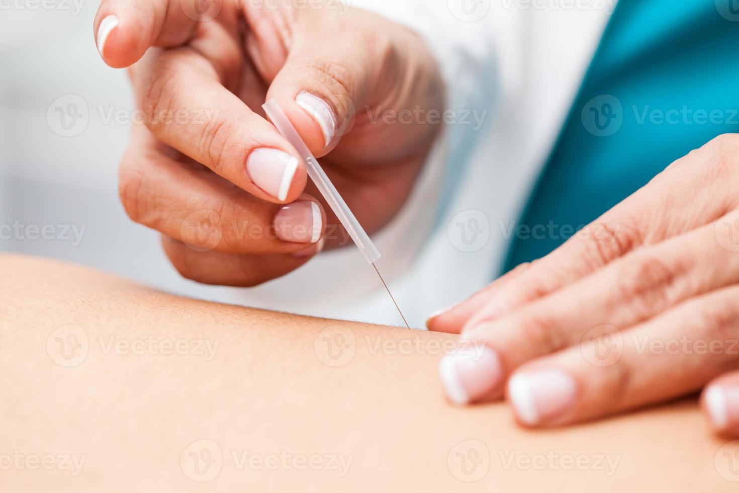 Doctor performing acupuncture on a young male patient photo