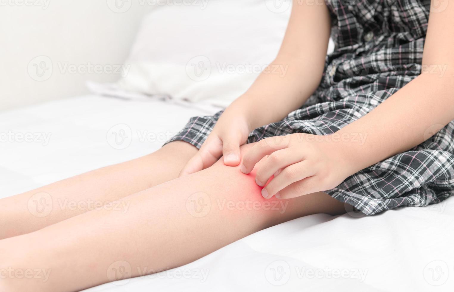 Hand scratching ,legs of little girl with swelling spot photo