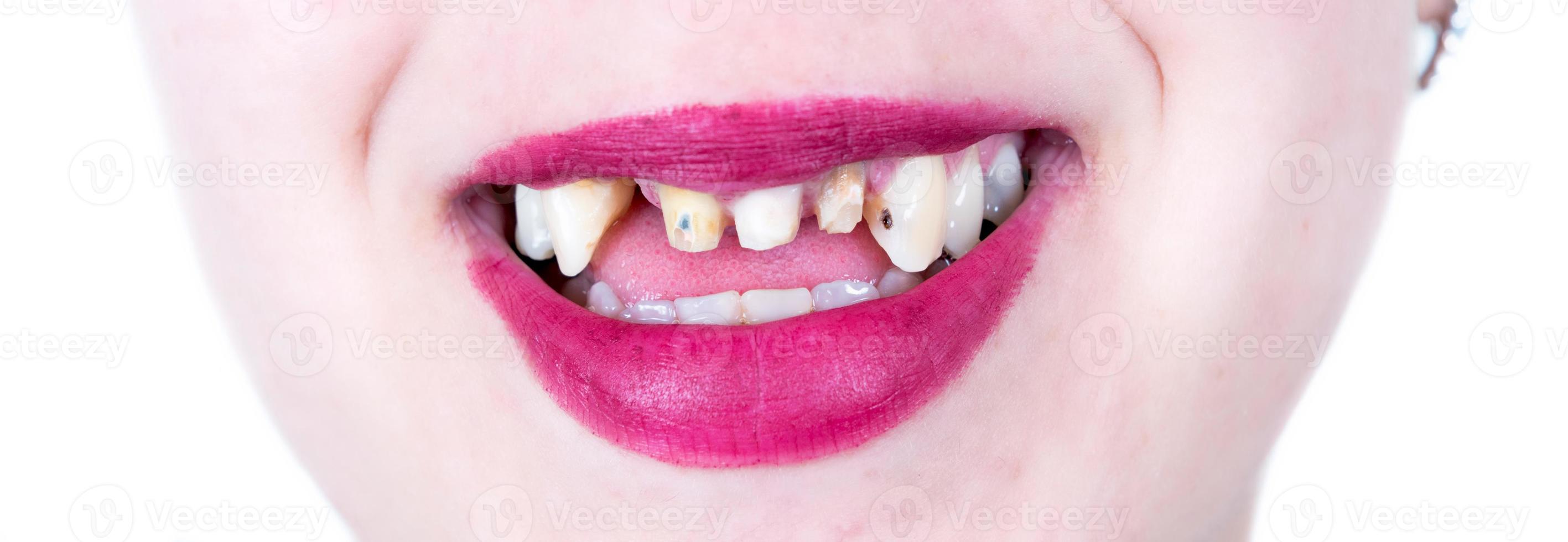 Female smile with no teeth photo