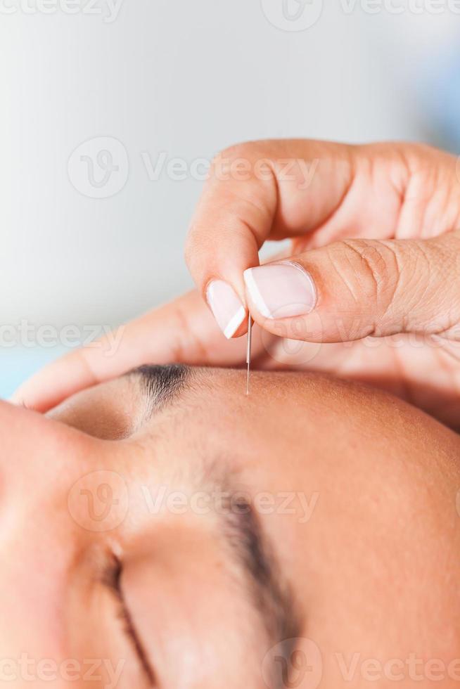 médico ejecutando facial acupuntura en un joven masculino paciente foto