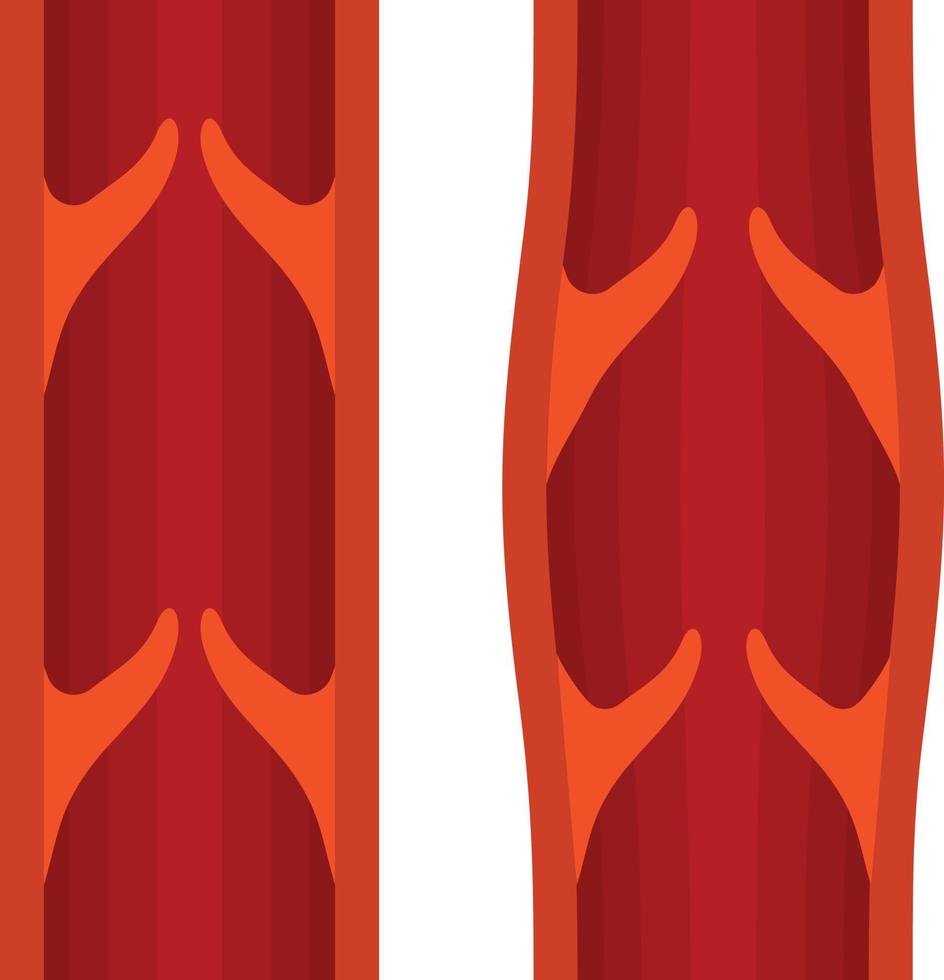 Vector Image Of Normal And Varicose Veins