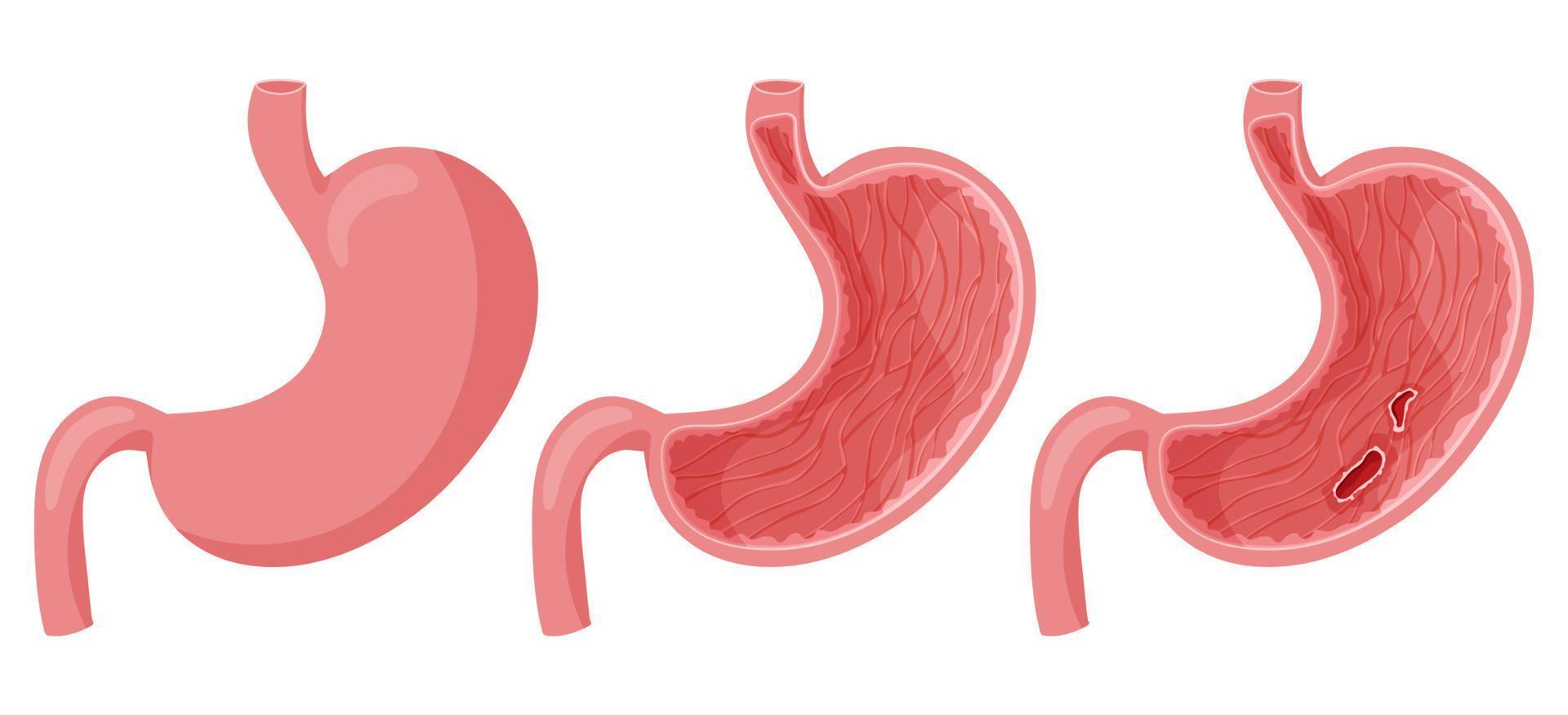 Peptic ulcer in human stomach vector
