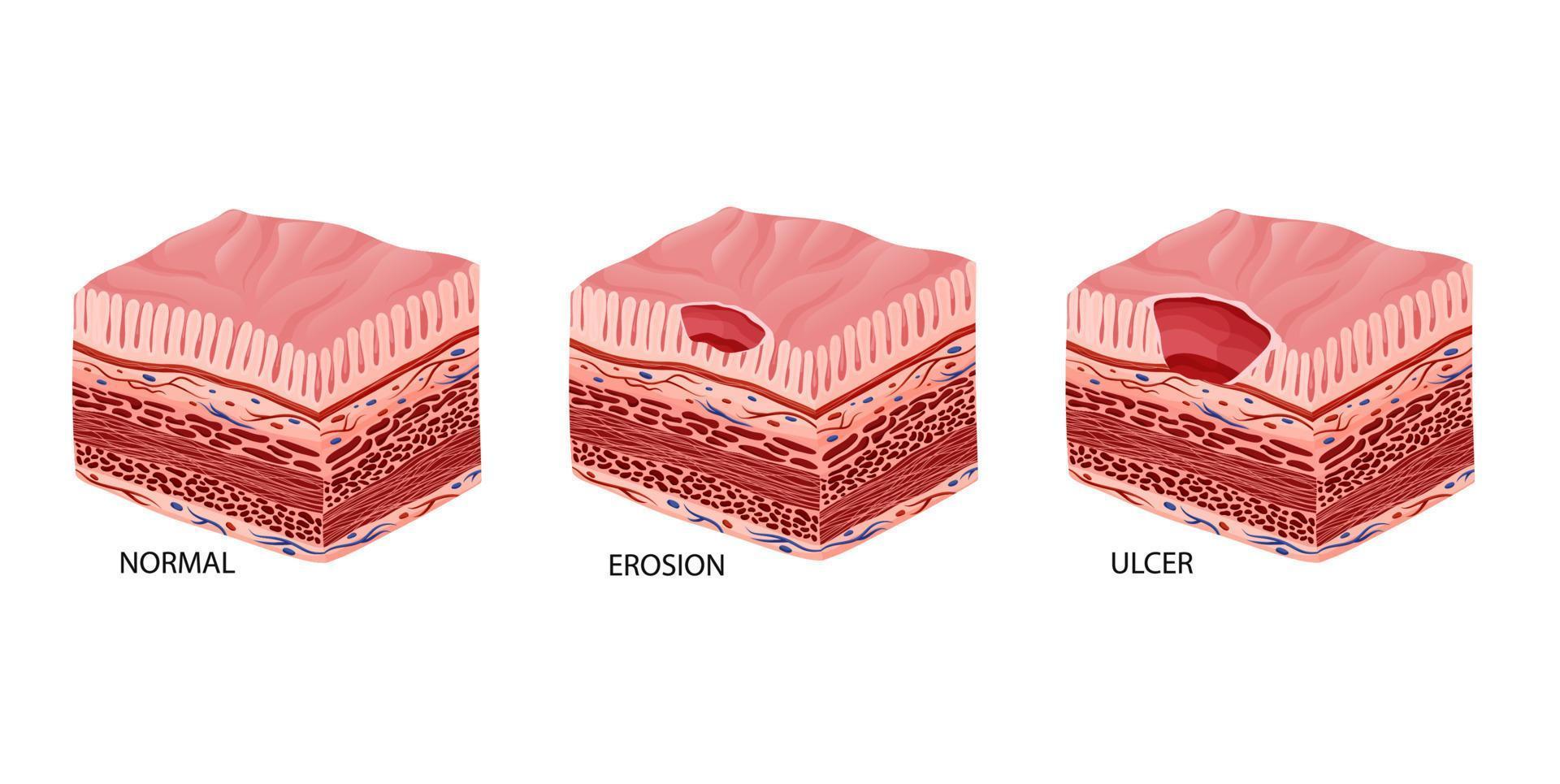 Peptic ulcer stages development illustration vector