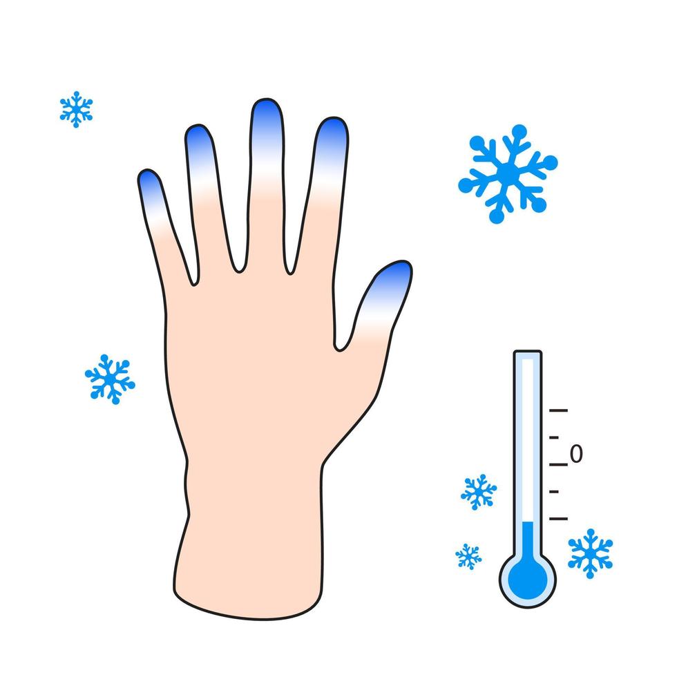 Frostbite. Hand with frostbite symptoms. effect of cold on human fingers. Vector