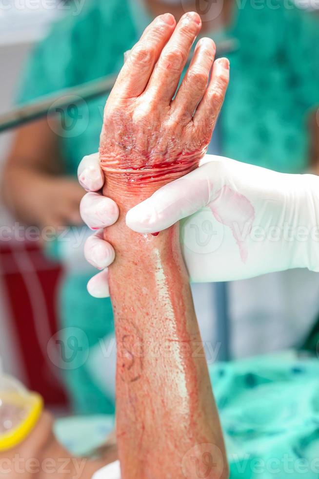 médico desinfectar el mano de un paciente previo a un mano cirugía foto