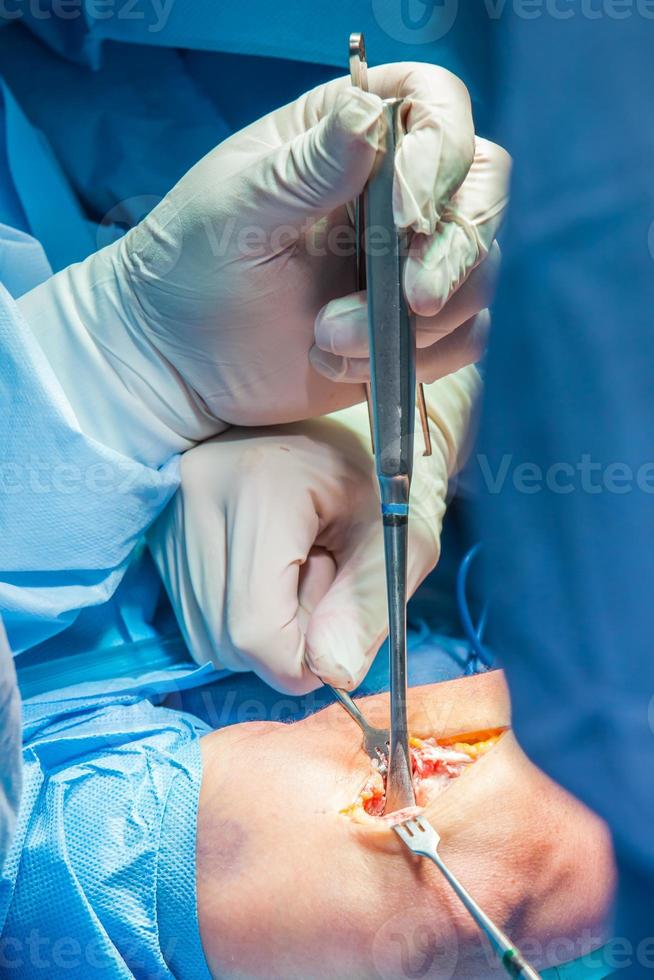 Group of orthopedic surgeons performing surgery on a patient arm photo