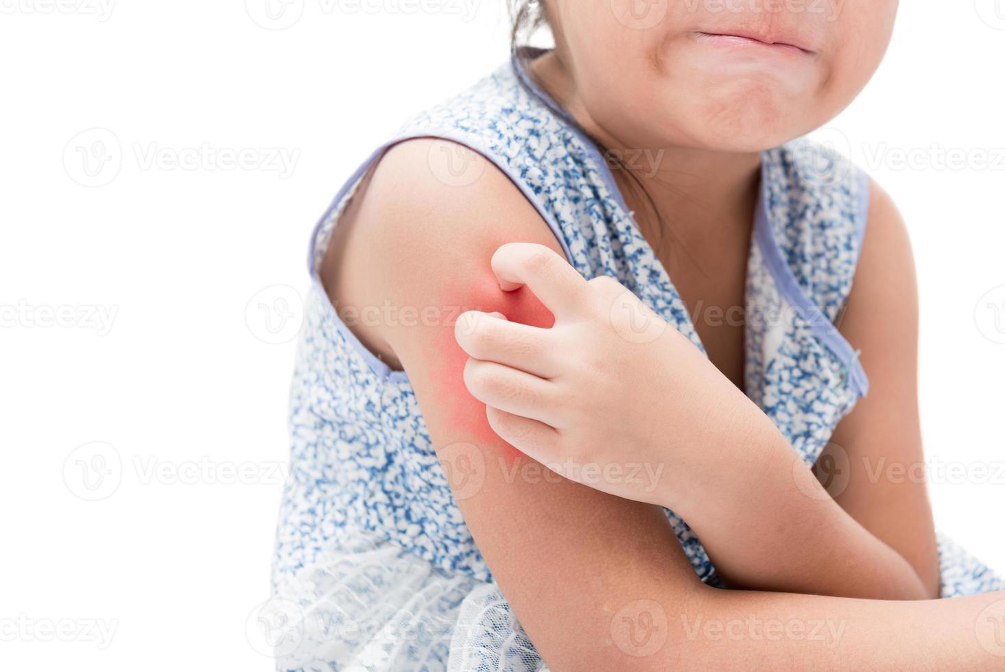 asian girl scratch the itch with hand her arm because of mosquito photo