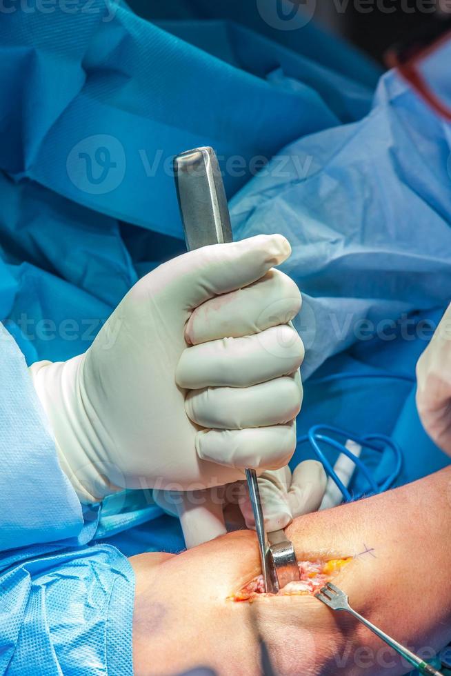 Group of surgeons performing an elbow surgery photo