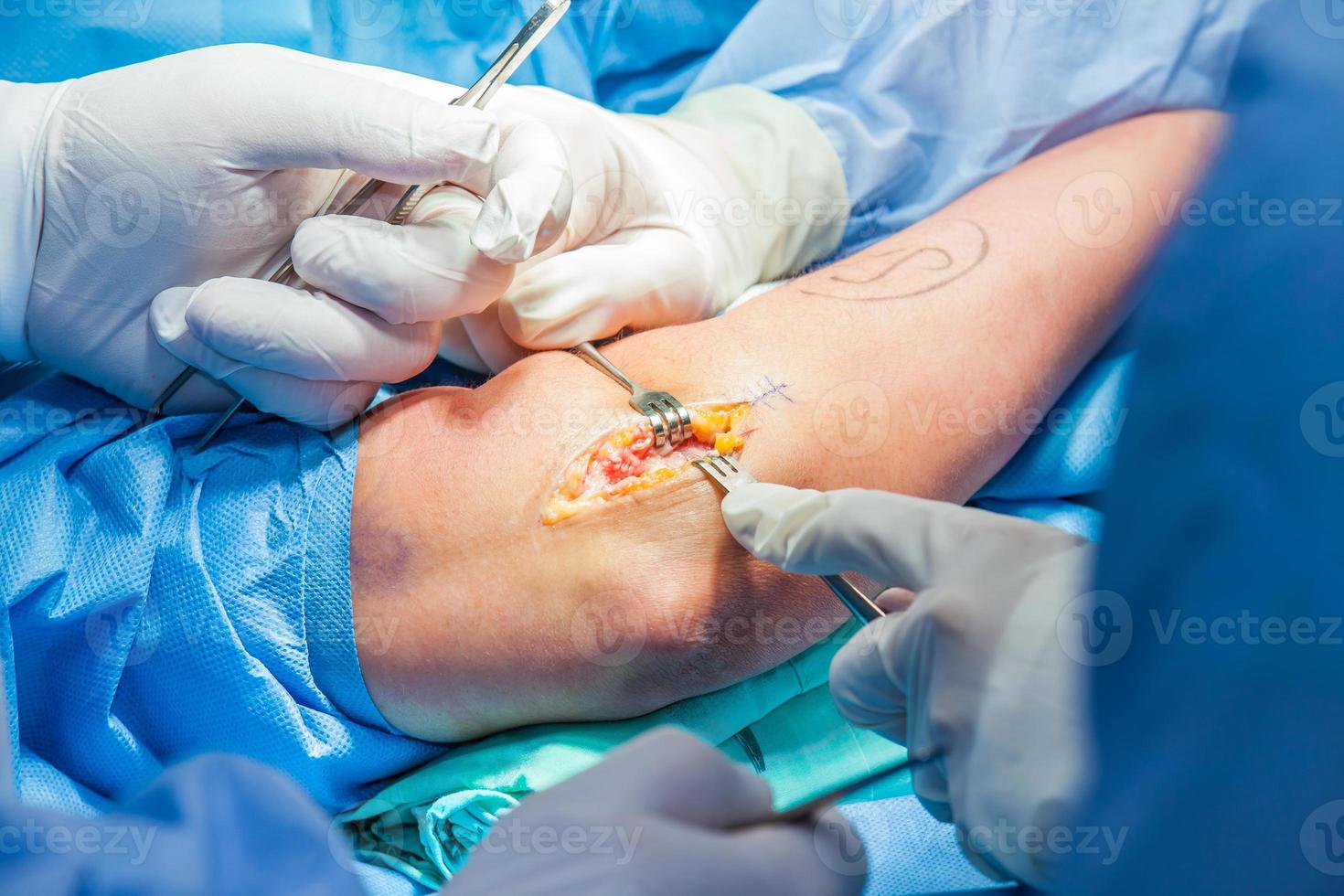 Group of orthopedic surgeons performing surgery on a patient arm photo