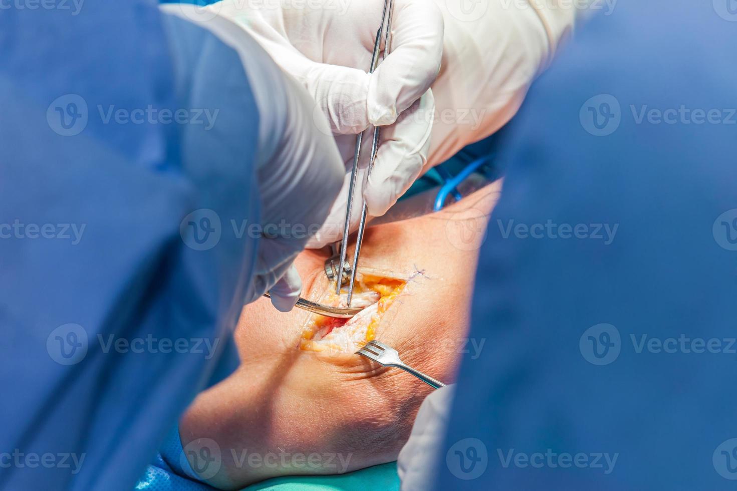 Group of orthopedic surgeons performing surgery on a patient arm photo