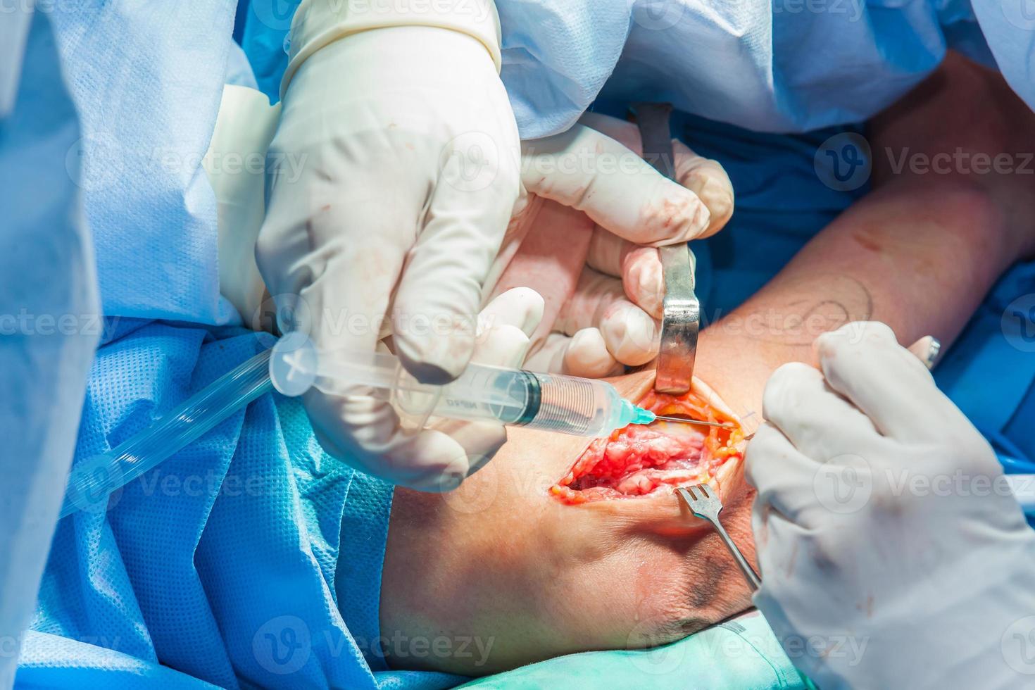 Group of orthopedic surgeons performing surgery on a patient arm photo
