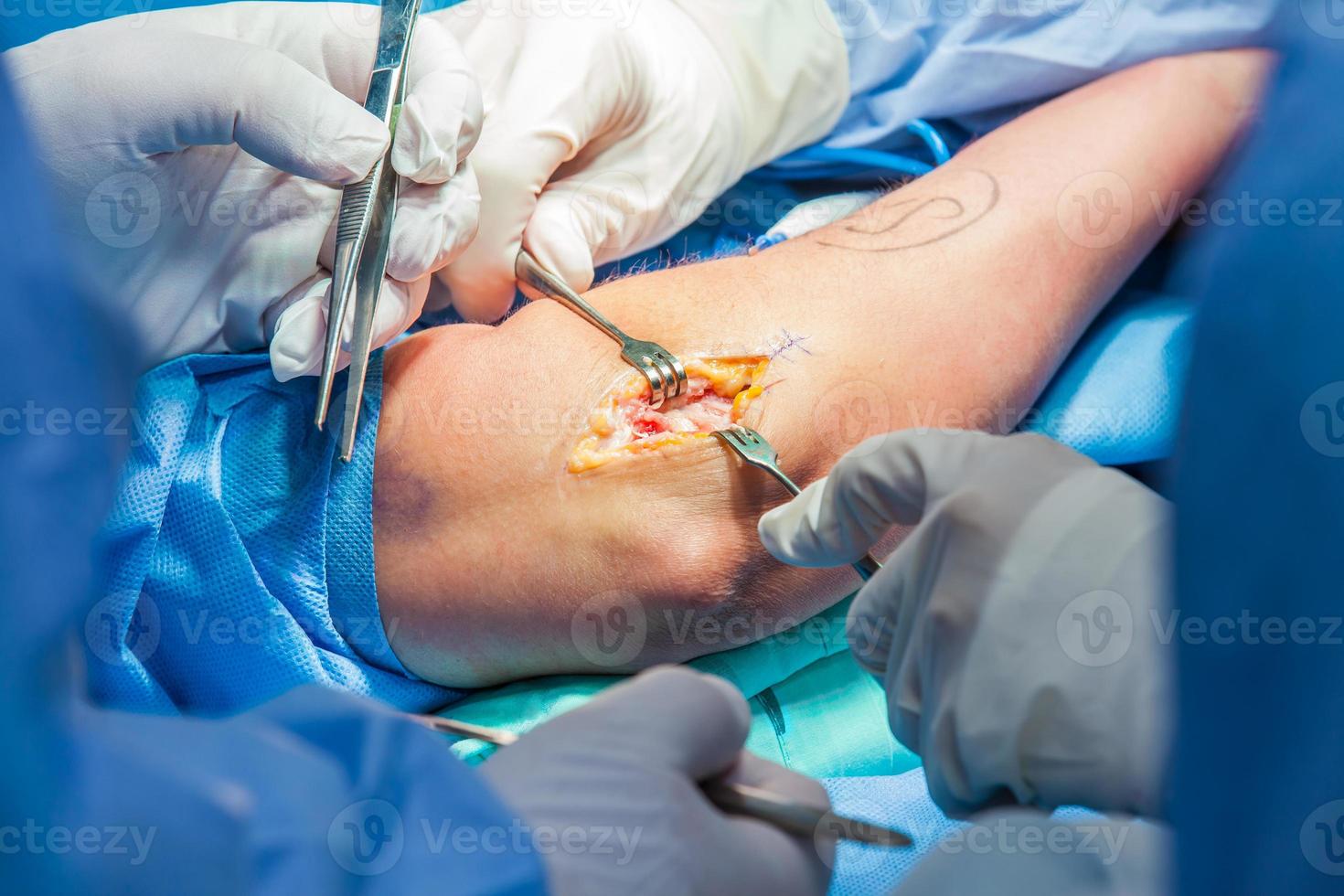 grupo de ortopédico cirujanos ejecutando cirugía en un paciente brazo foto