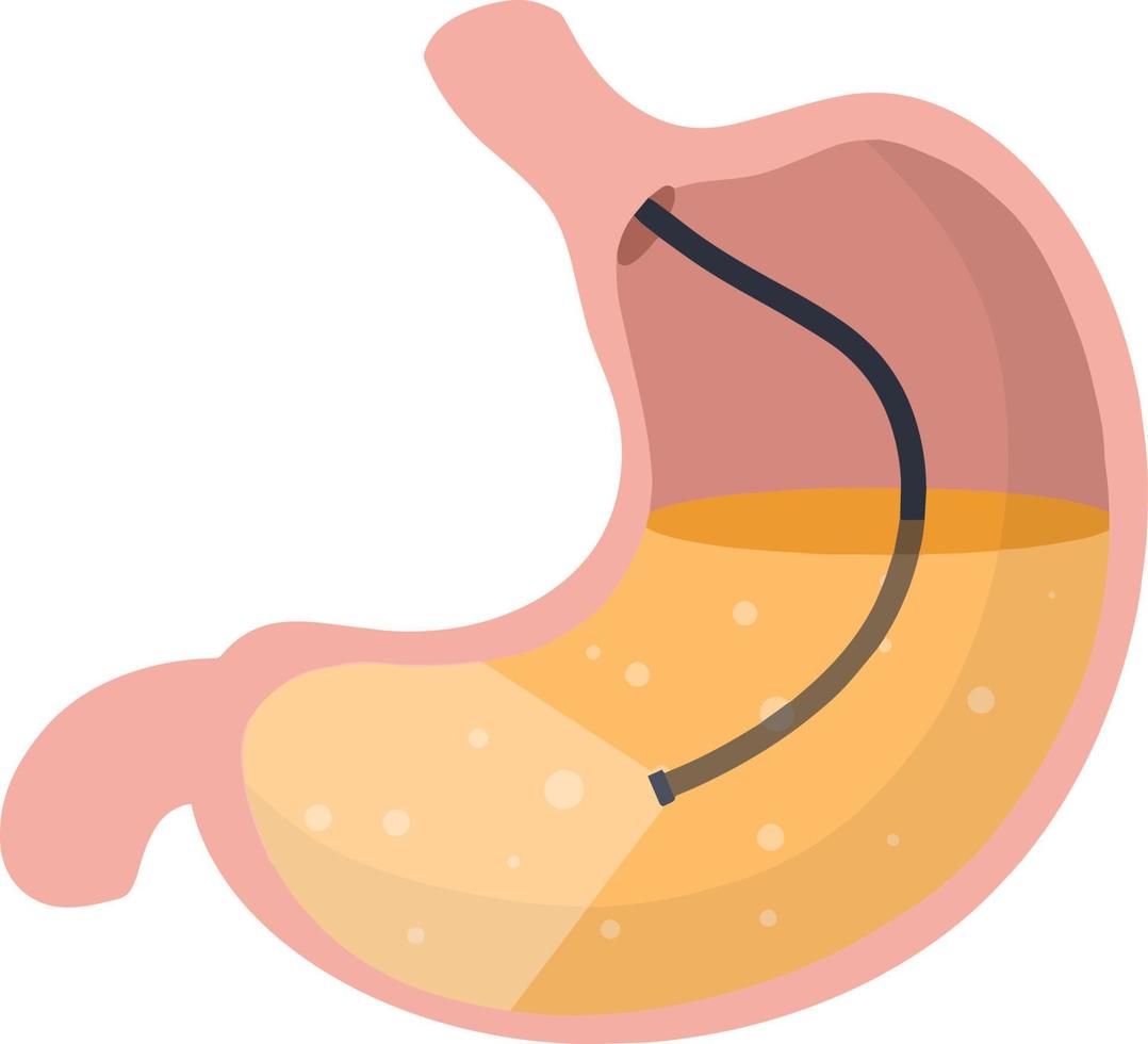 gastroscopia. endoscopia y digestivo problemas. manguera con cámara. procedimiento con interno órganos dibujos animados plano ilustración. médico visual inspección de estómago vector