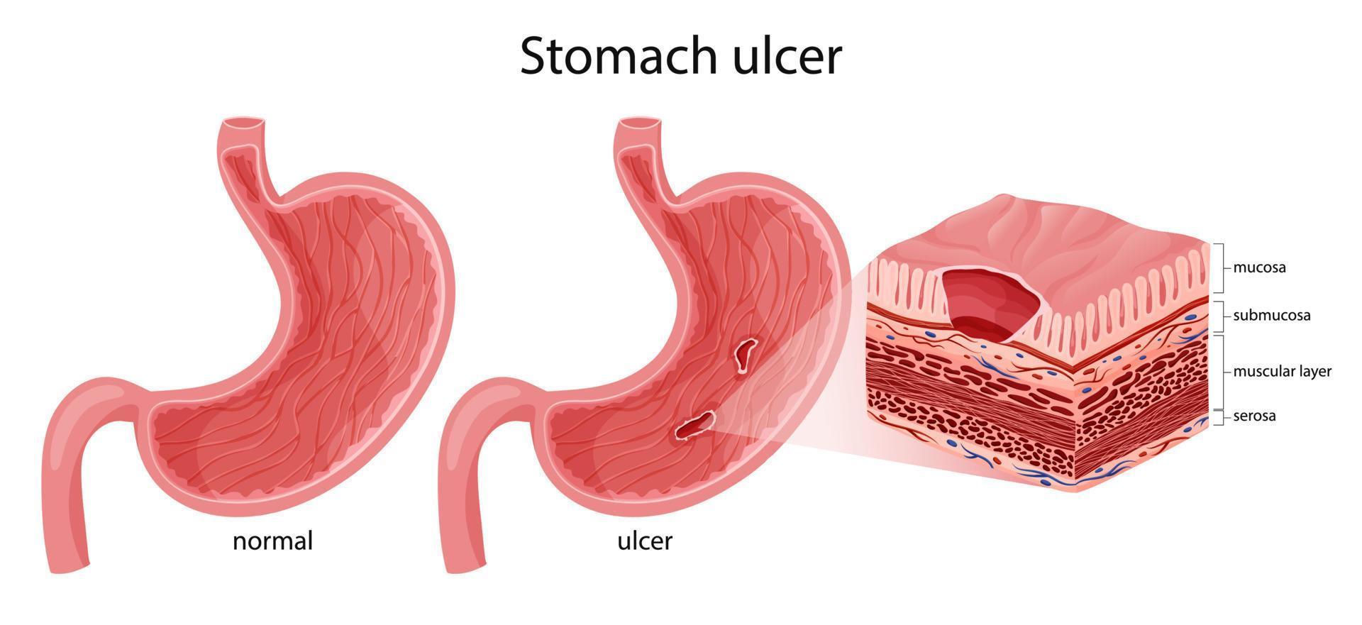 Normal stomach and peptic ulcer illustration vector