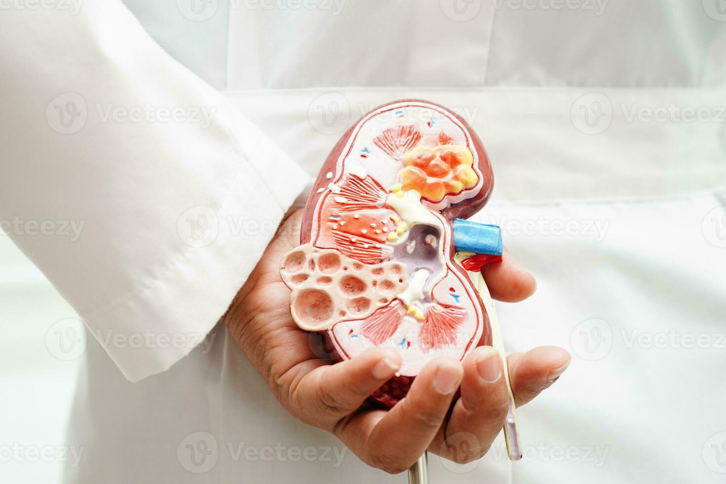 Chronic kidney disease, doctor holding model for treatment urinary system, urology, Estimated glomerular filtration rate eGFR. photo