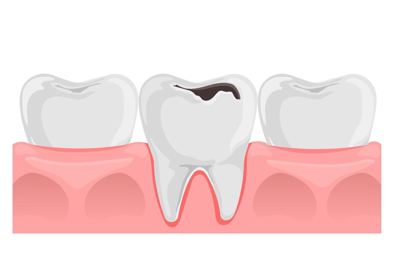 dientes con caries en chicle. dental anatomía. plano vector ilustración aislado en blanco.