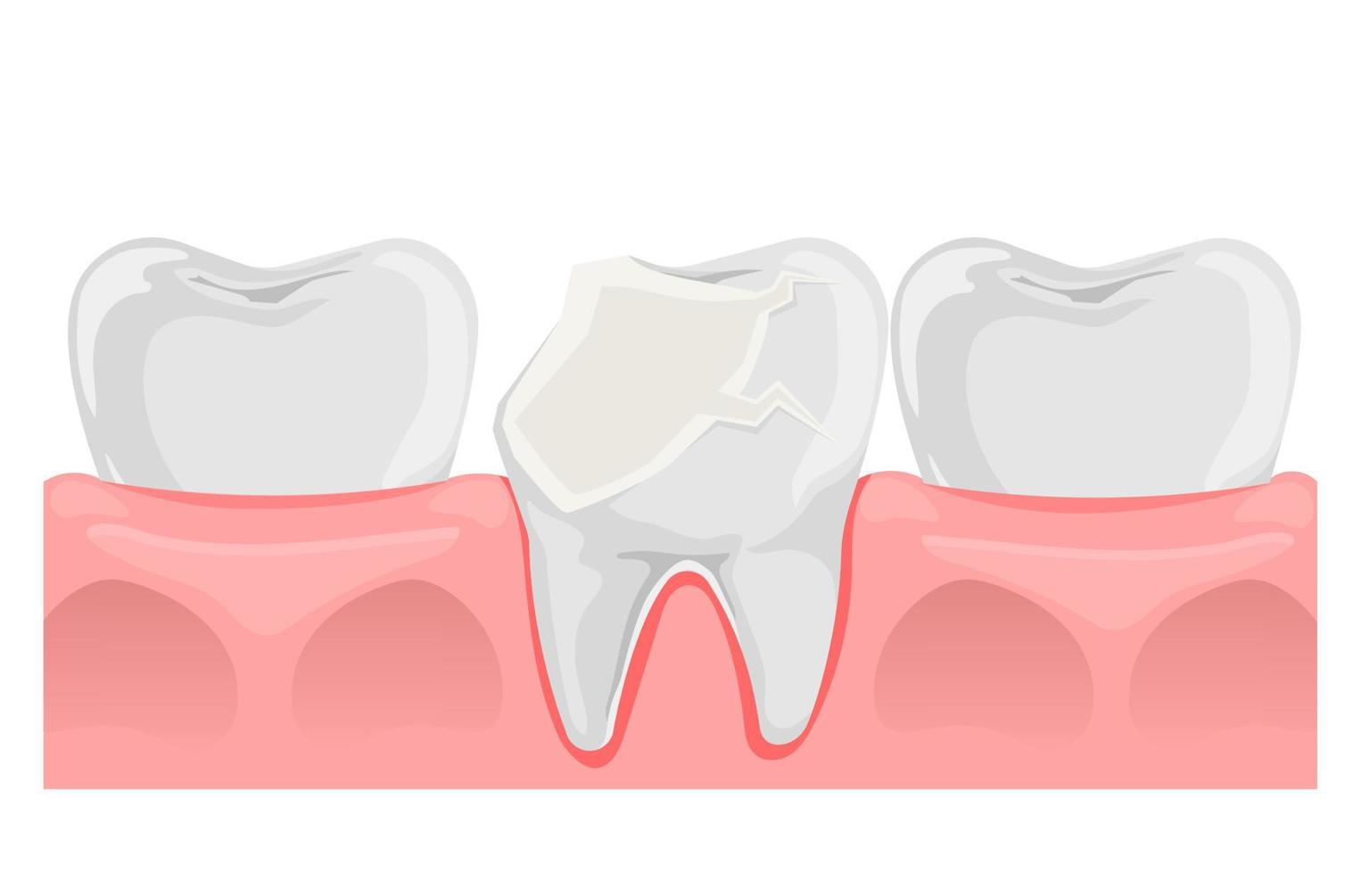 Broken Tooth. Cracked tooth in flat style. Teeth and gum anatomy. Dental health. Vector illustration isolated on white.