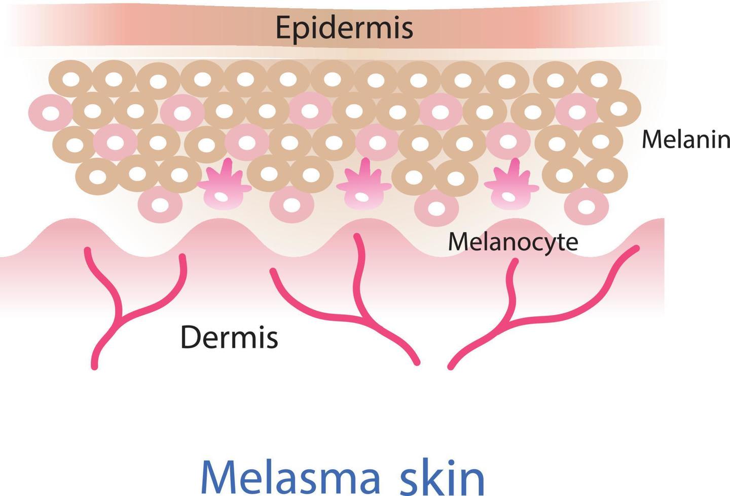 The mechanism of melasma skin vector. Beauty skin care concept illustration. vector