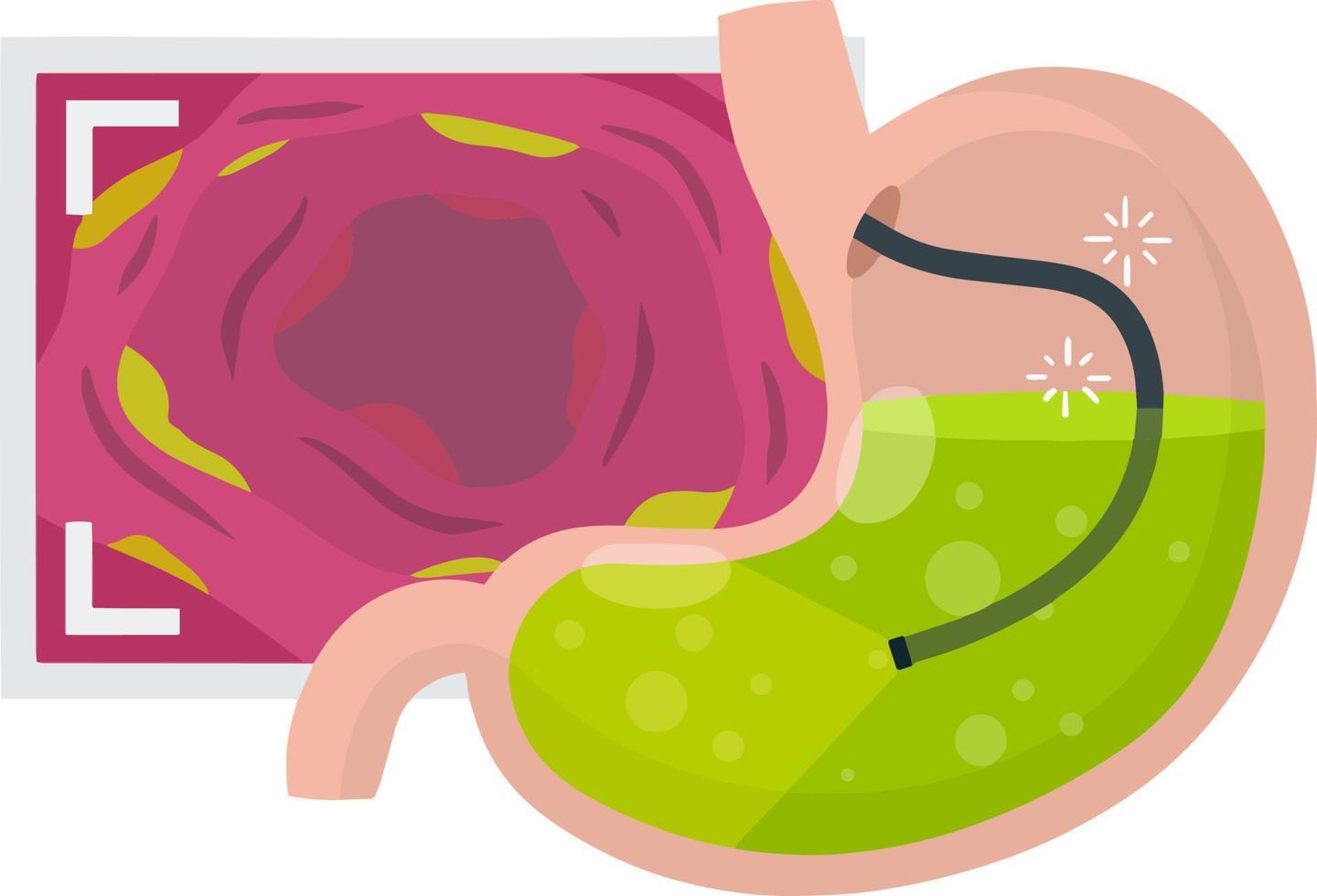 Gastroscopy. Endoscopy and digestive problems. Hose with camera. Procedure with internal organs. Cartoon flat illustration. Medical Visual inspection of stomach vector