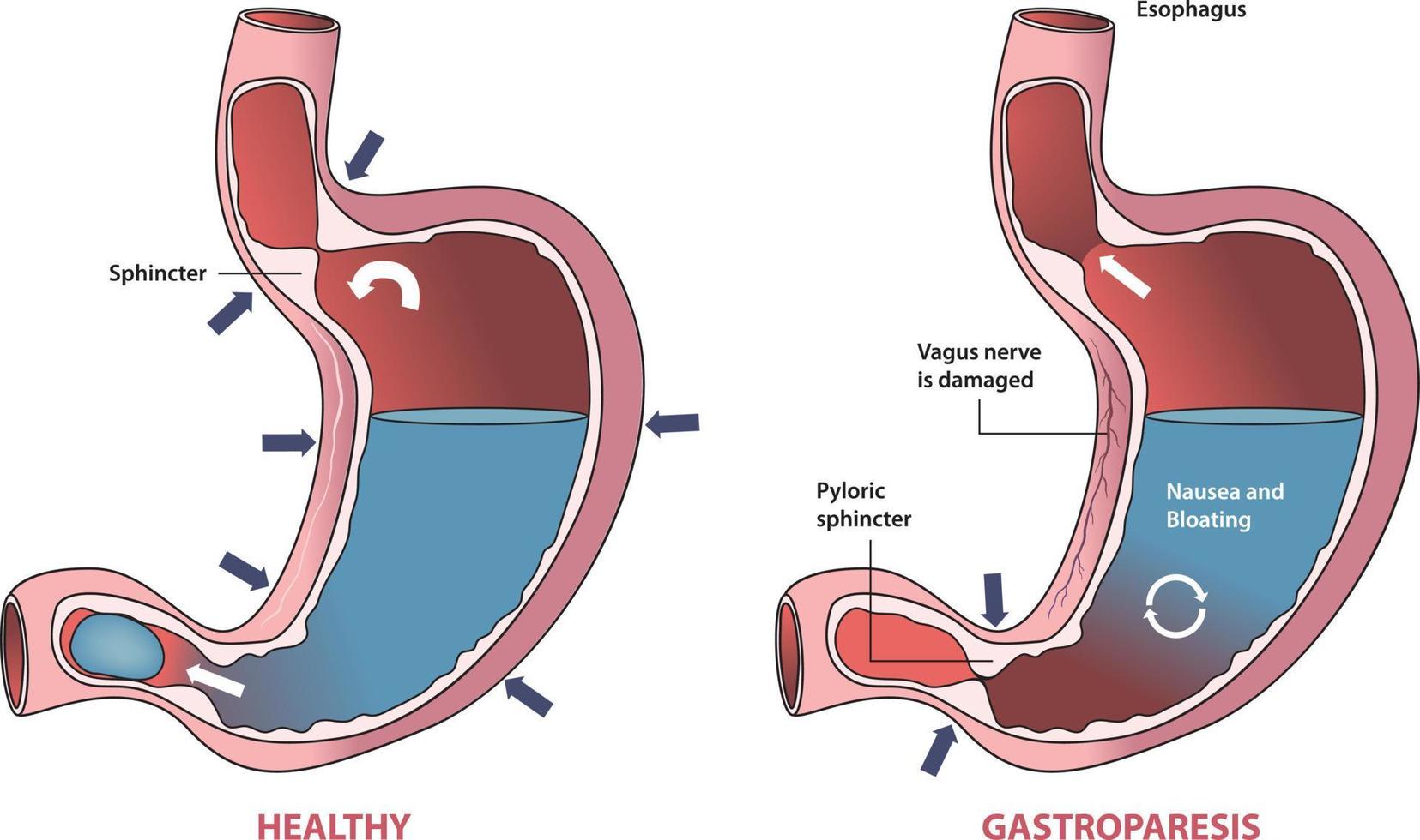 illustration of healthy stomach and gastroparesis condition vector