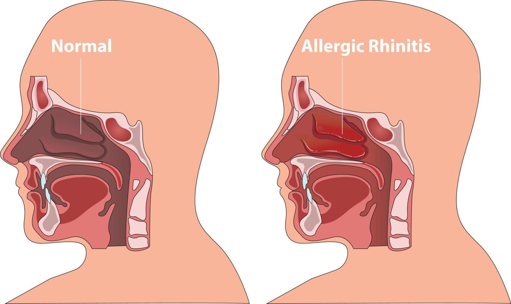 healthy nasal passage vs rhinitis allergies vector