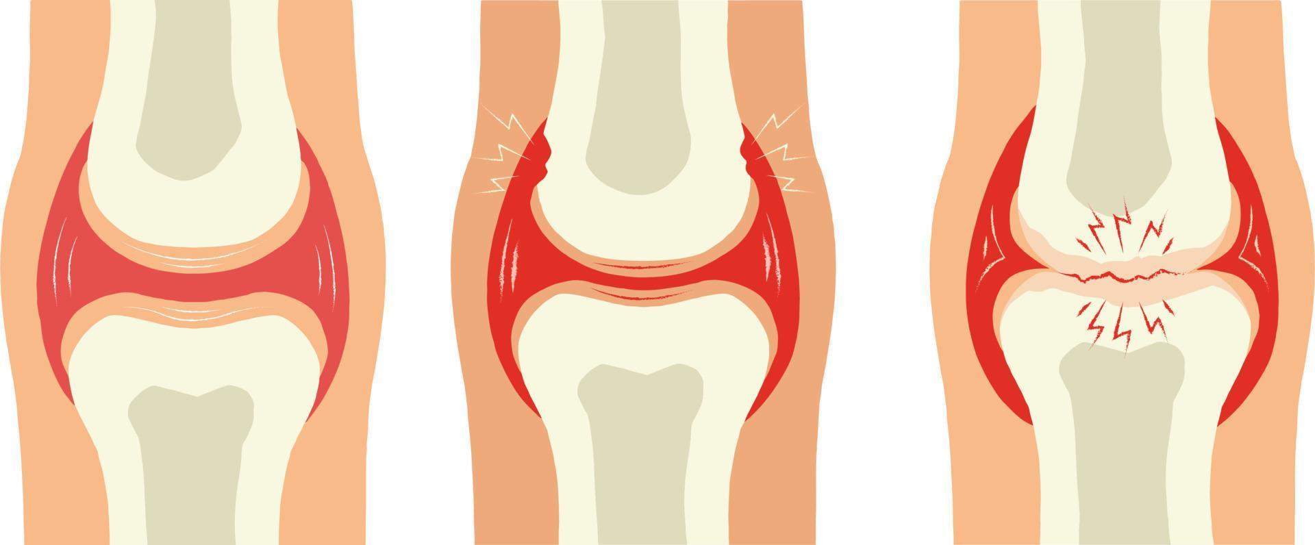 rodilla articulación dolor. vector ilustración aislado en un blanco antecedentes.