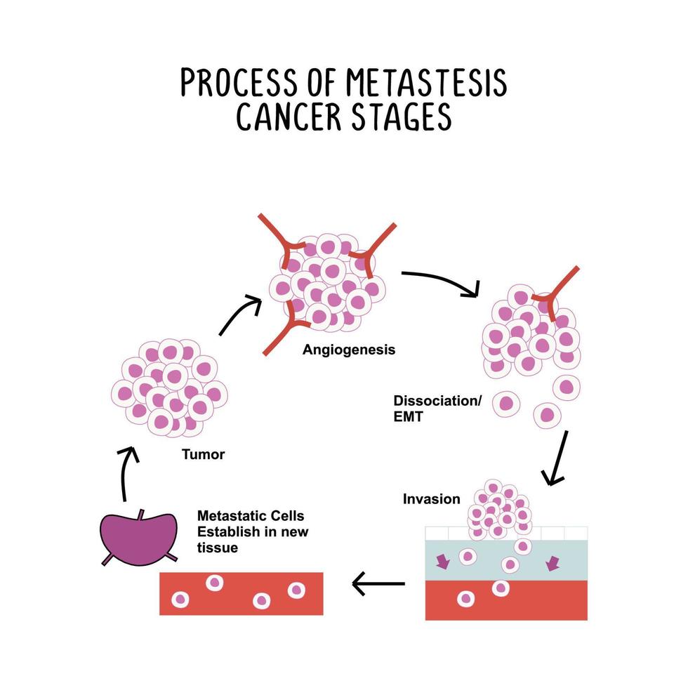 process of metastases cancer stages illustration on white background