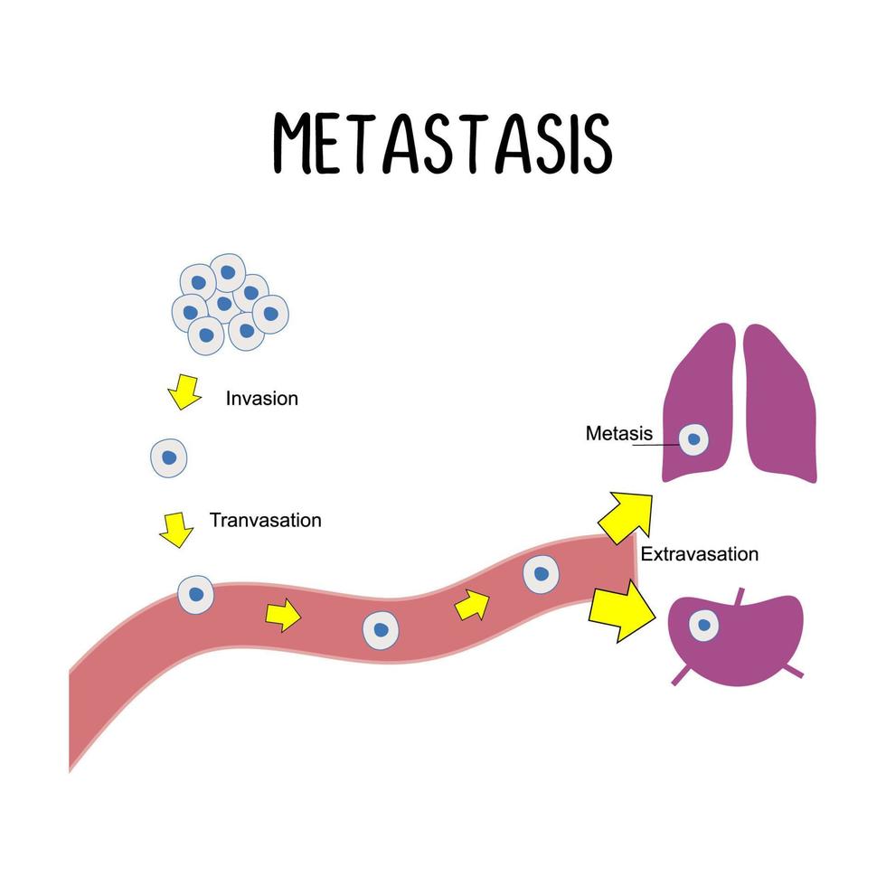 Metastasis The spread of cancer cells from the original tumor vector