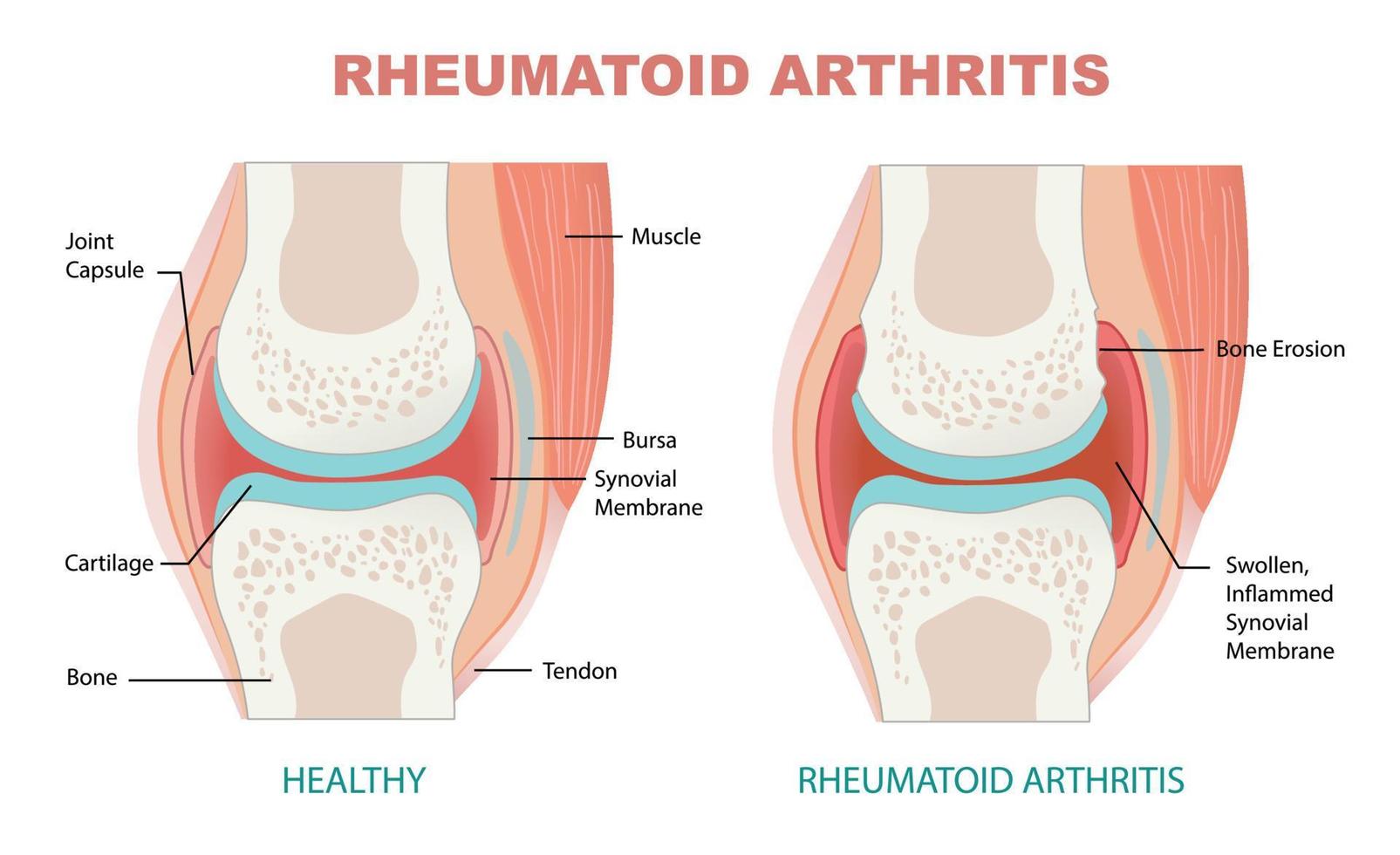 comparison between rheumatoid arthritis and healthy joint vector