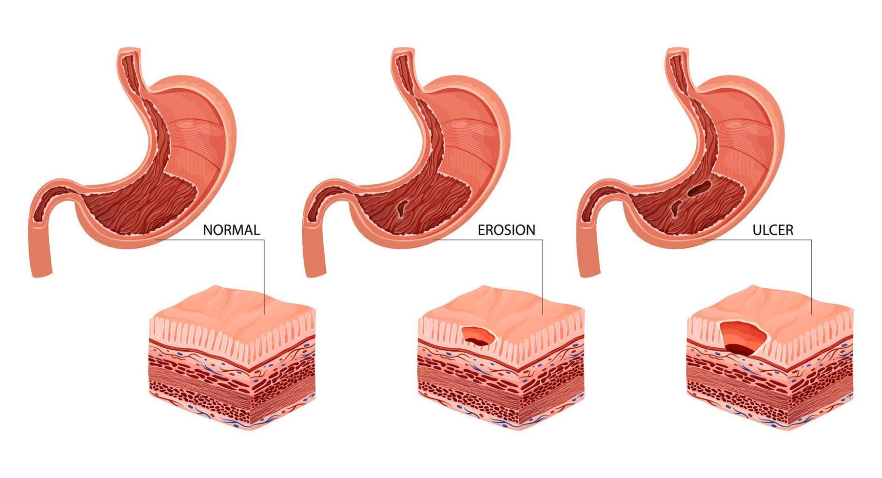 Stomach erosion and ulcer illustration vector