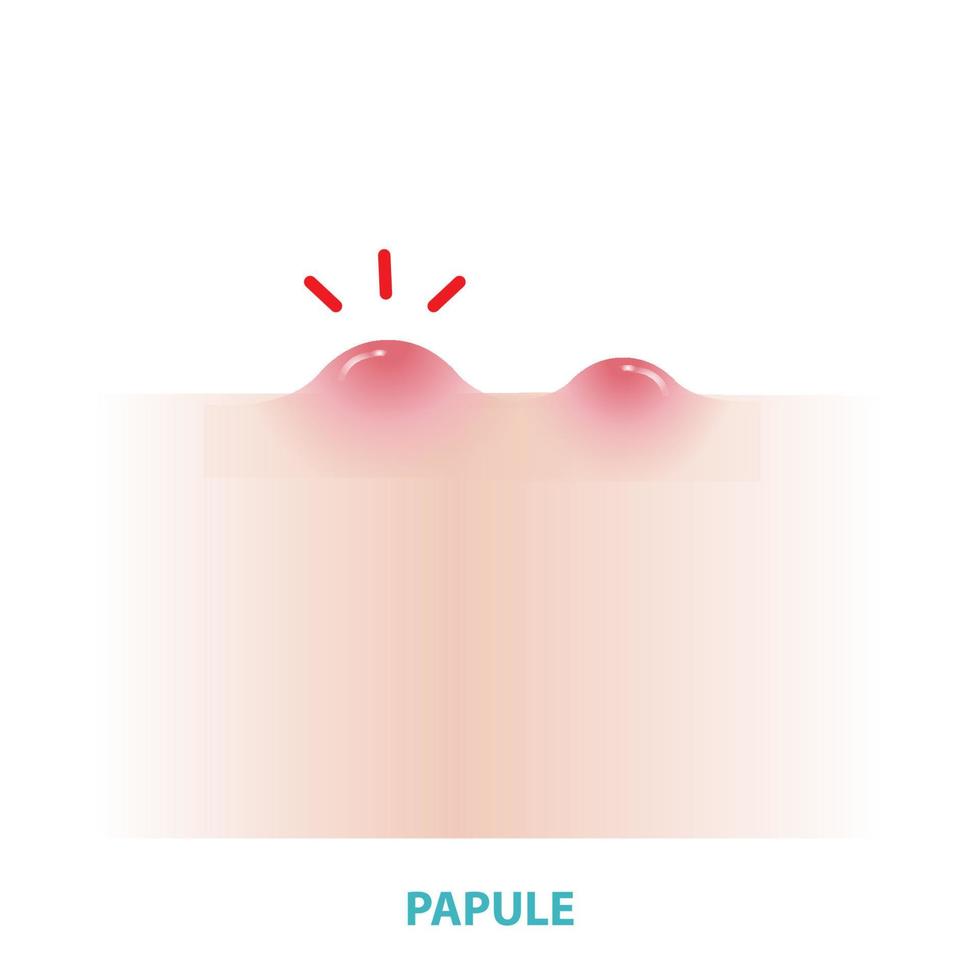 Papule acne vector on white background. Formation of inflammatory acne, papule, small, raised, solid pimple or swelling, forming on the skin and  inflamed. Flat design vector acne illustration.