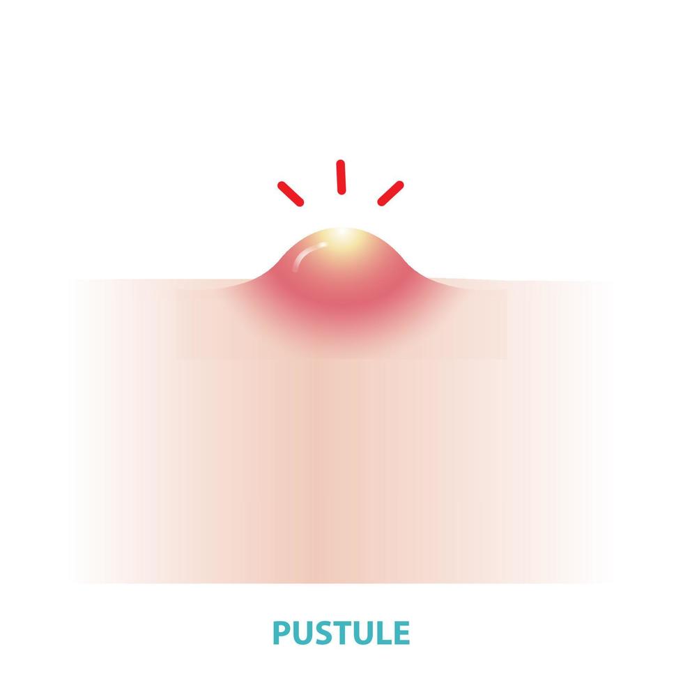 Pustule acne vector isolated on white background. Formation of inflammatory acne, pustule, small blister or pimple on the skin inflamed and containing pus. Flat design vector acne illustration.