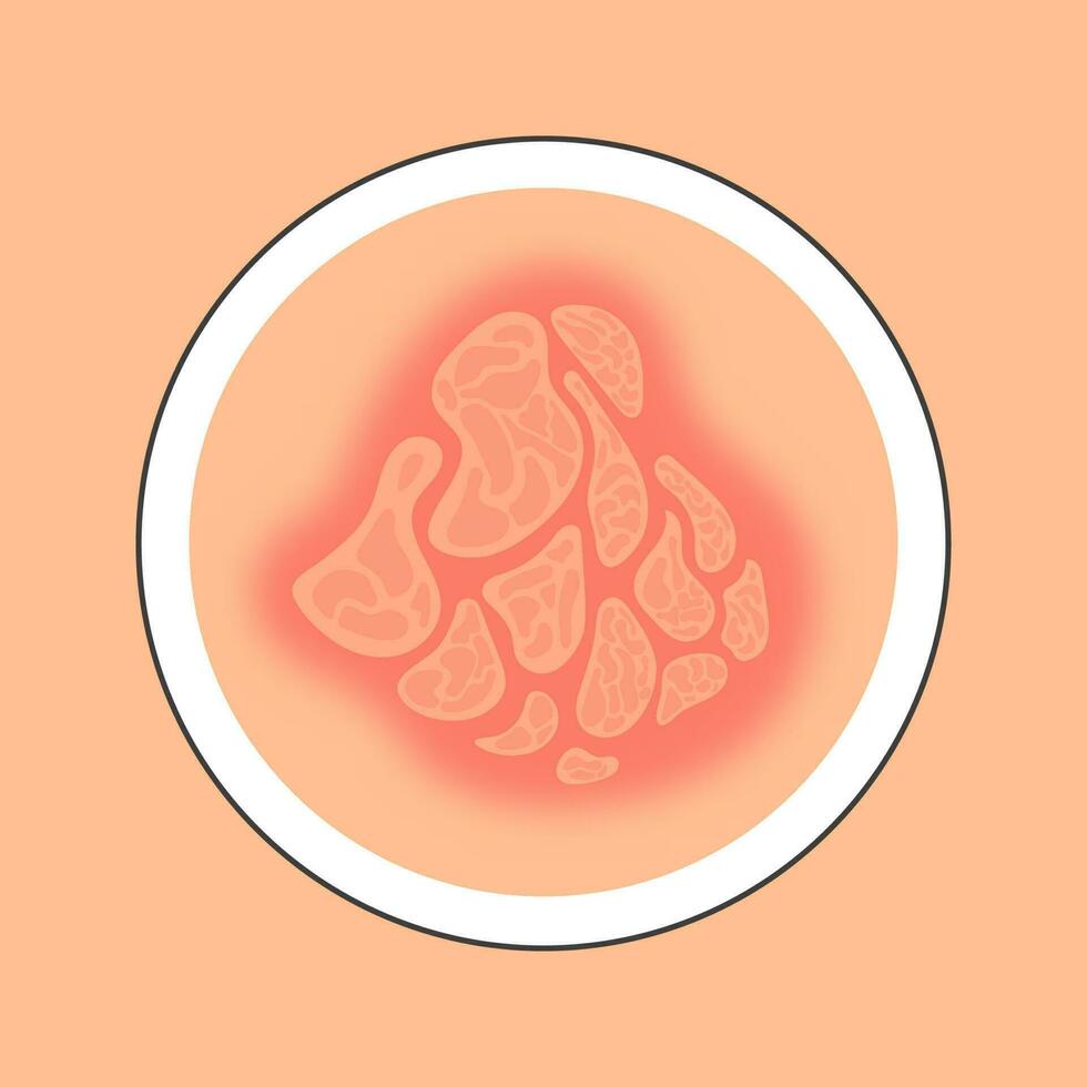 Flat Style Eczema Disease Skin Circle Icon In Red And Peach Color. vector